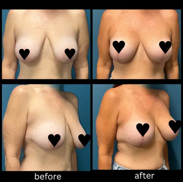 Breast Augmentation and Mastopexy April 17 2026