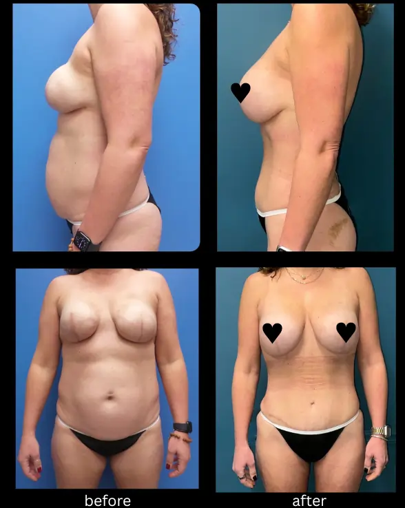 Mommy Makeover on Previous Breast Reconstruction April 17 2026