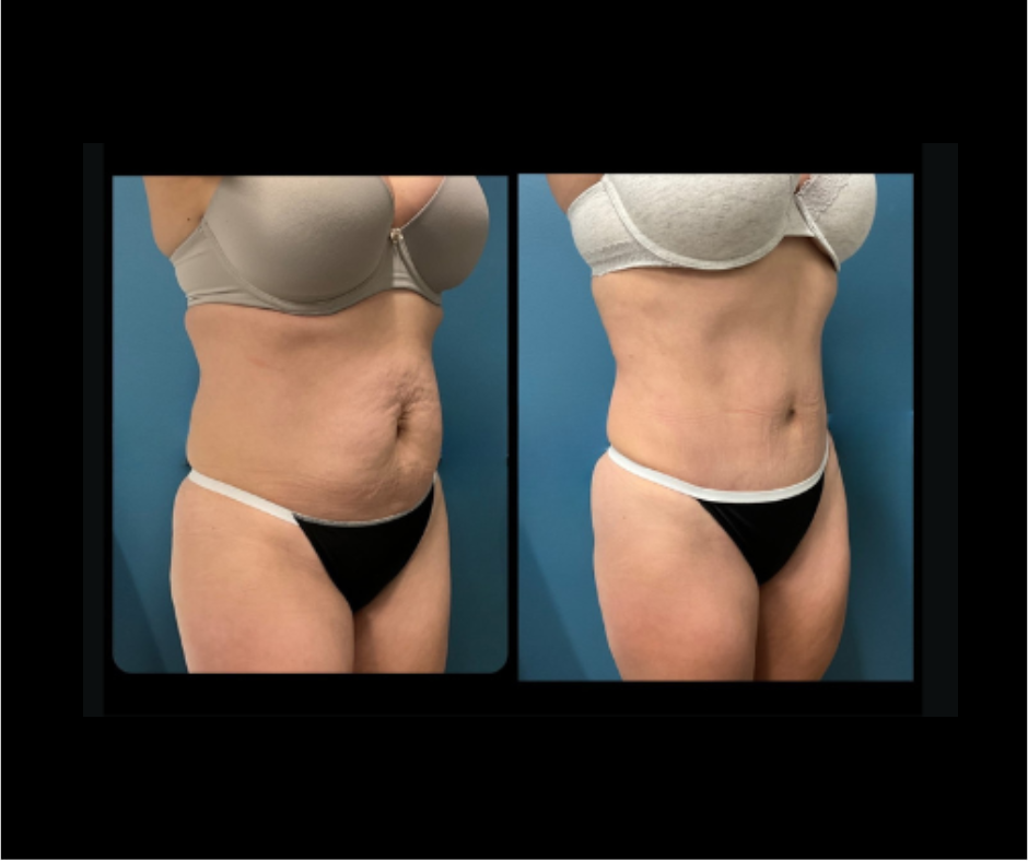 Tummy tuck 02