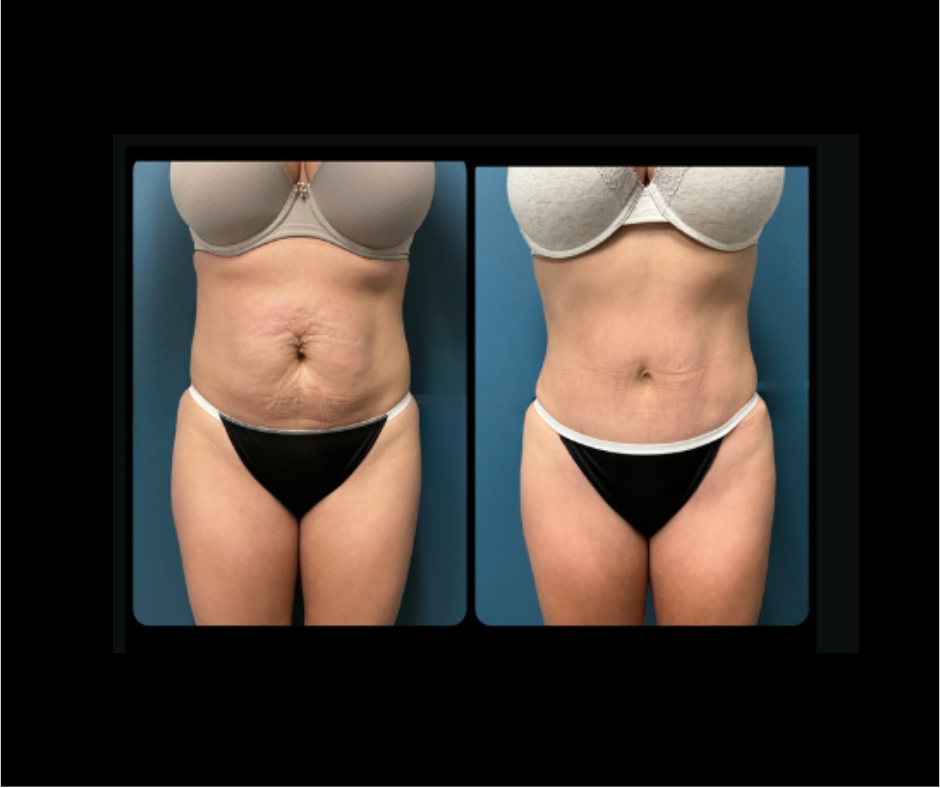 Tummy tuck 01
