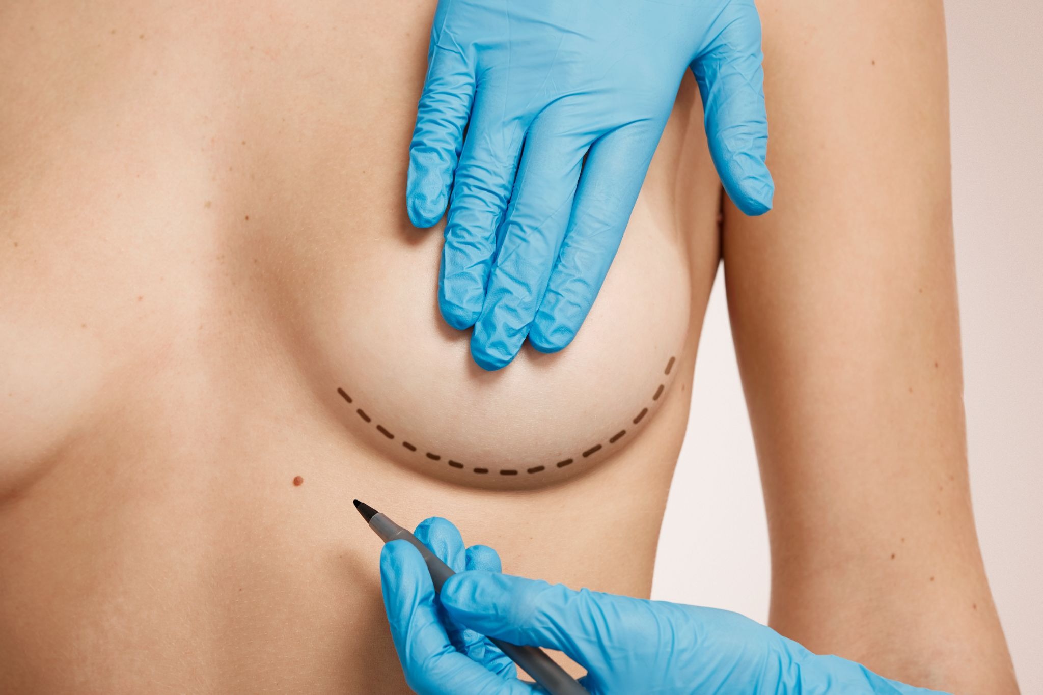 Plastic surgeon marking a patient’s breast before breast asymmetry surgery 