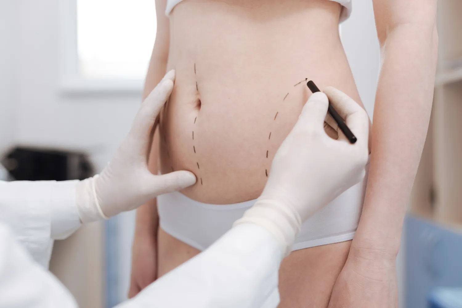A plastic surgeon wearing white surgical gloves drawing dotted surgical lines on a woman's abdomen in San Antonio.
