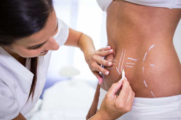 Liposuction consultation for a patient researching liposuction cost in San Antonio