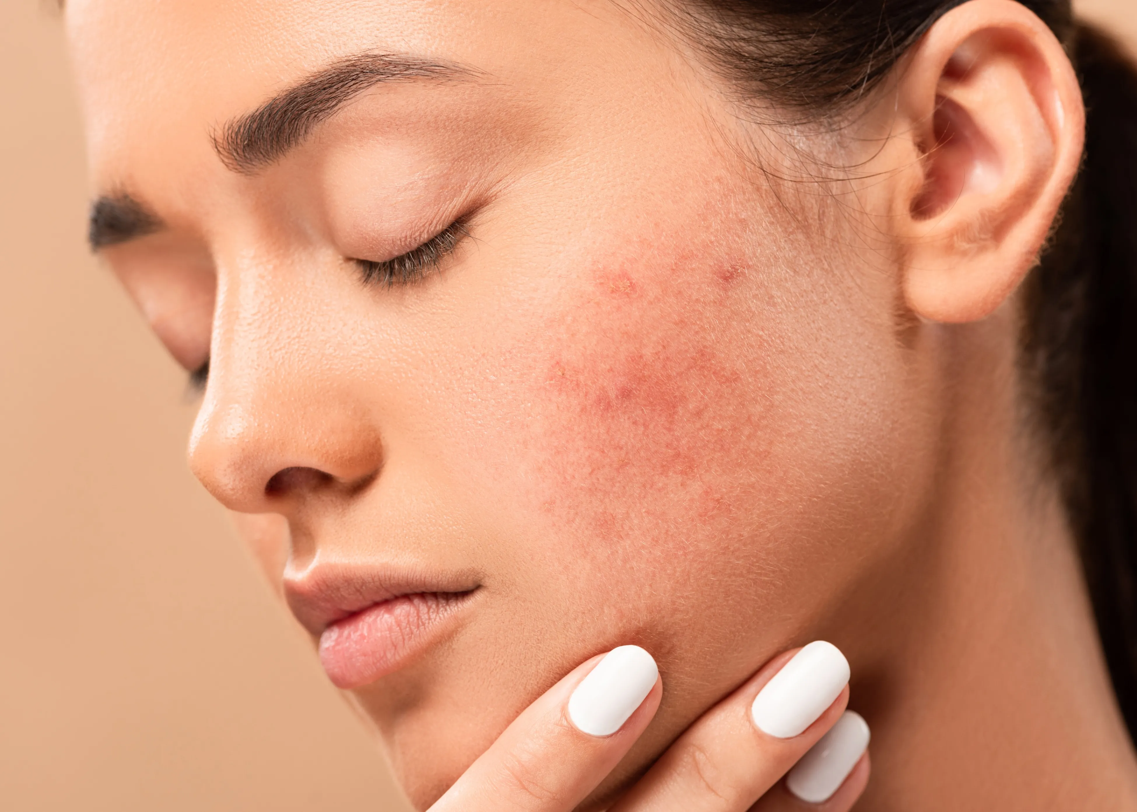 A woman with acne on her face.