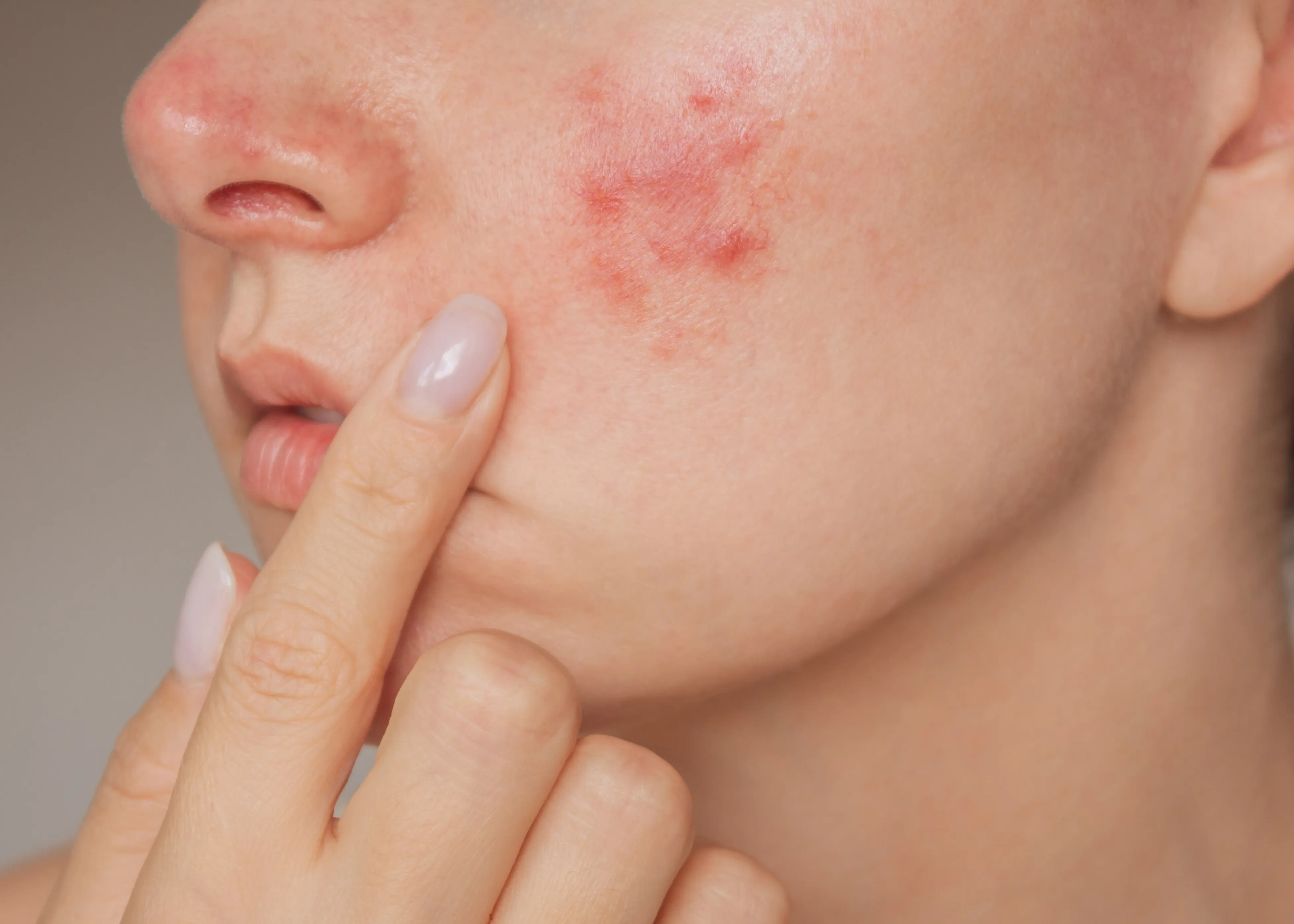 A woman with acne on her face.