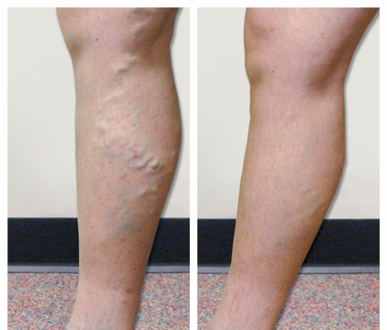 https://veinscarolina.com/wp-content/uploads/2019/03/varicose-vein-before-and-after-treatment.jpg