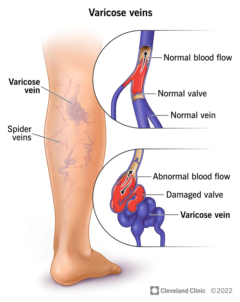Why Varicose Veins and Spider Veins Cause Pain