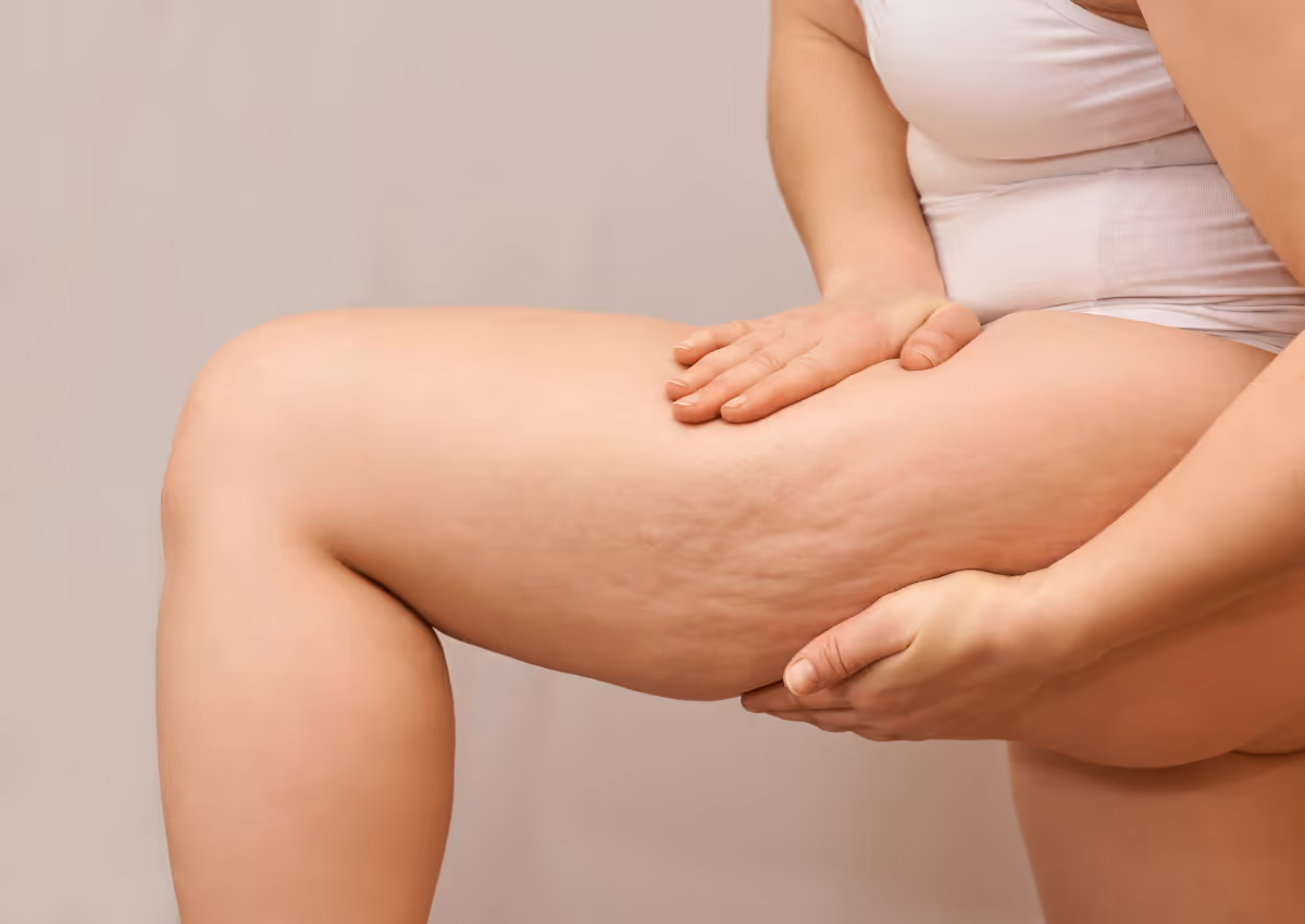 Cellulite treat at modern wellness clinic