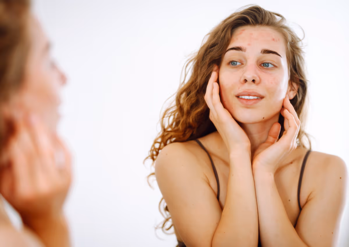 Best Acne Treatments in Las Vegas