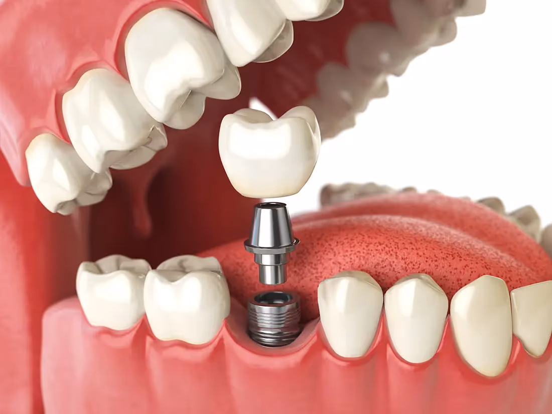 Implant Crowns