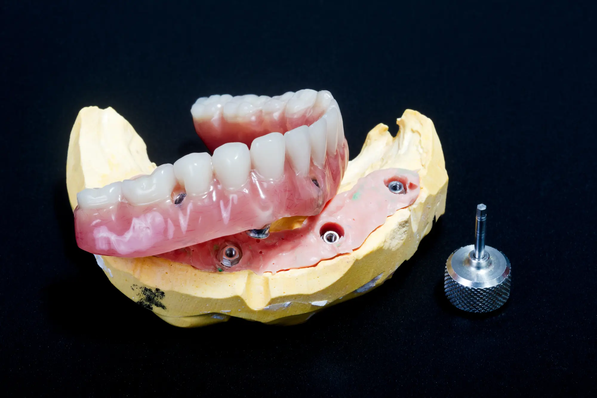 All-on-X Treatment in Auburn, ME | Center For Advanced Dentistry