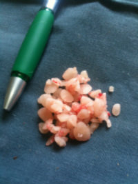 The stones that were removed