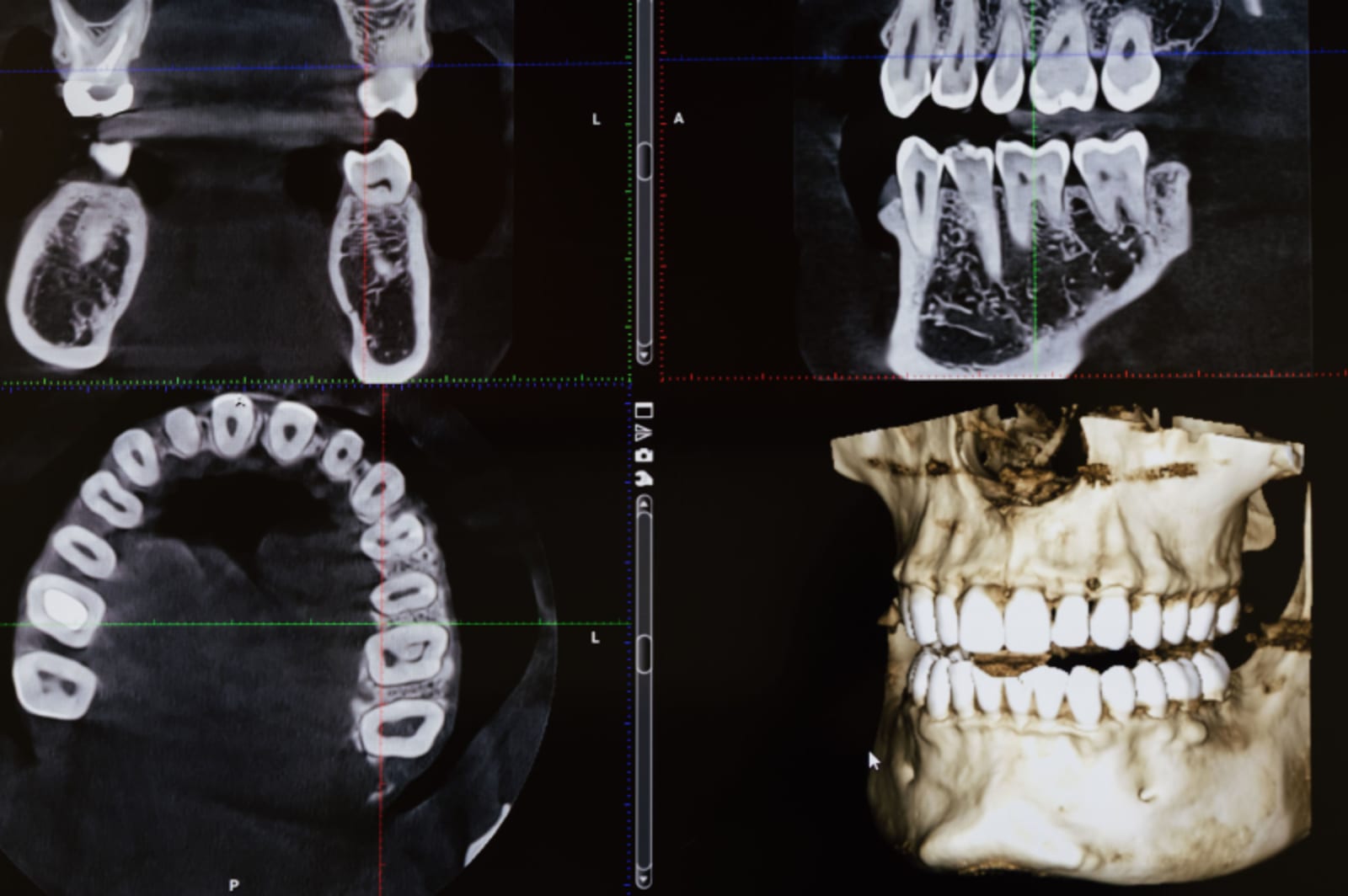 Dental X-rays displayed on screen showing teeth and jaw structure for diagnosis