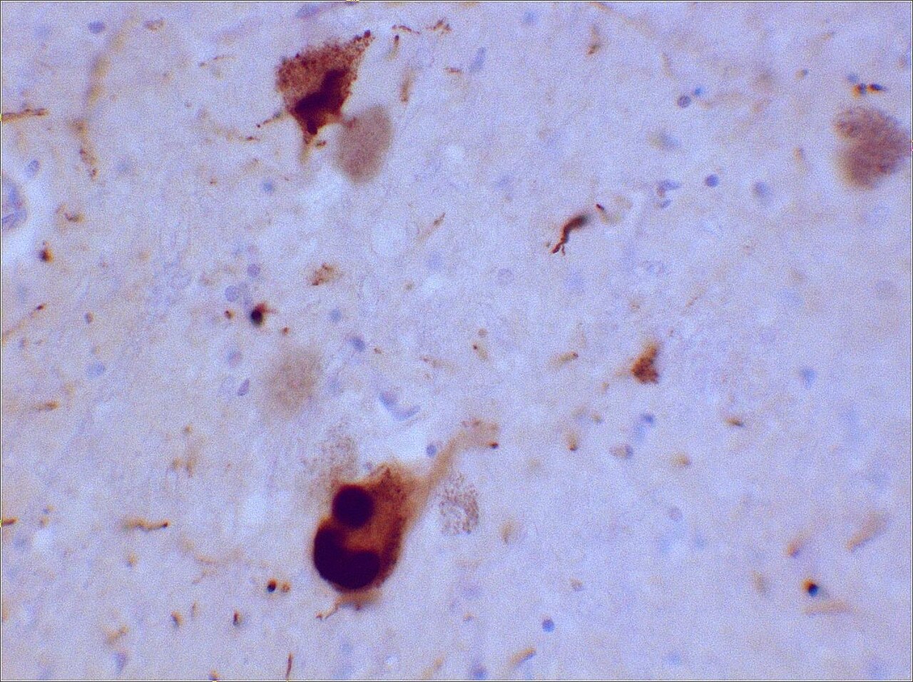 Micrograph of brain tissue immunostained for alpha-synuclein, showing dark rounded Lewy body inclusions inside neurons