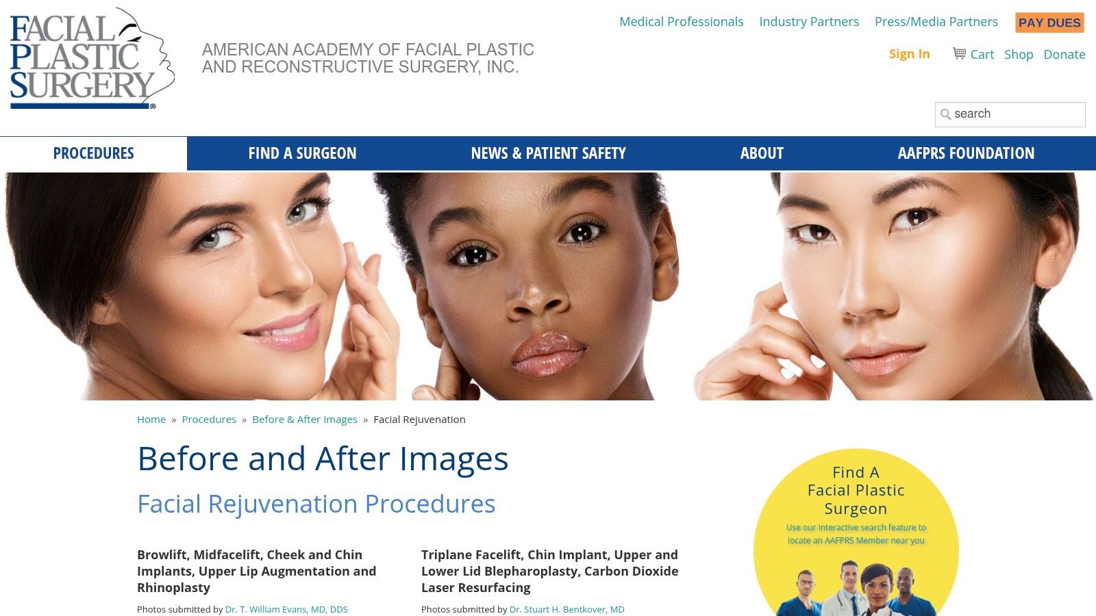 American Academy of Facial Plastic and Reconstructive Surgery (AAFPRS) – Before & After