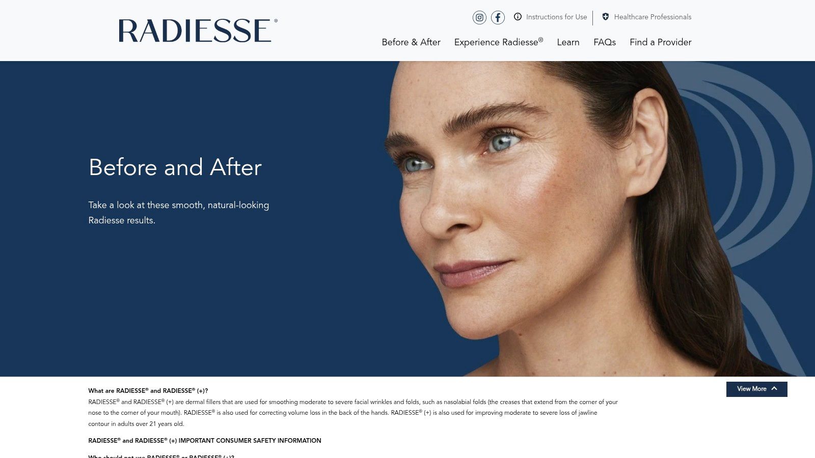 Radiesse (Merz Aesthetics) - Official Site