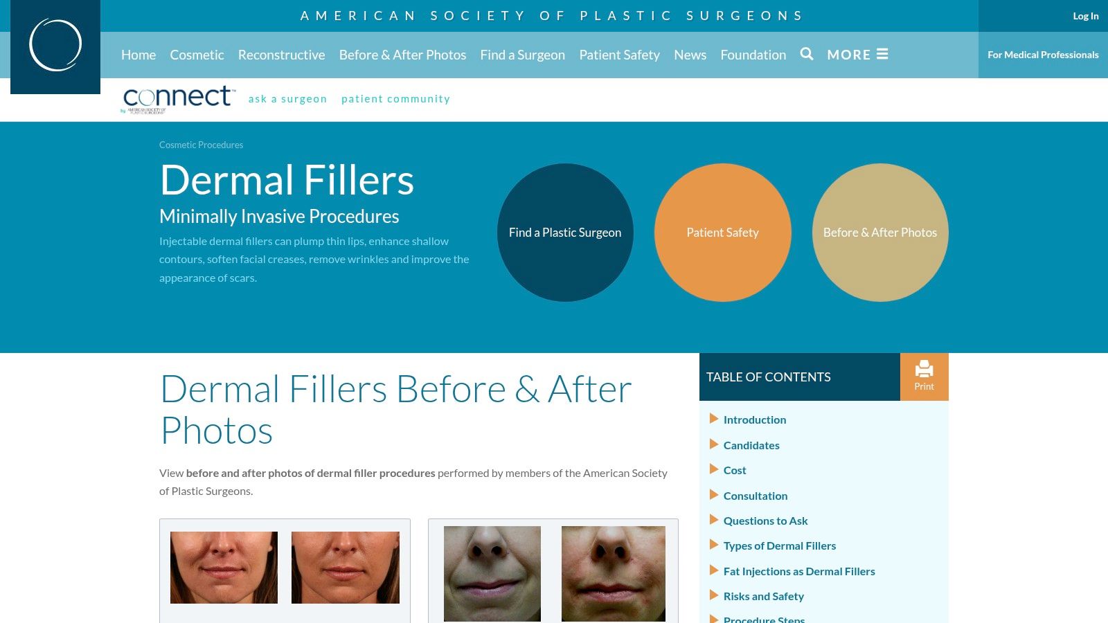 American Society of Plastic Surgeons (ASPS) – Dermal Fillers Photo Gallery