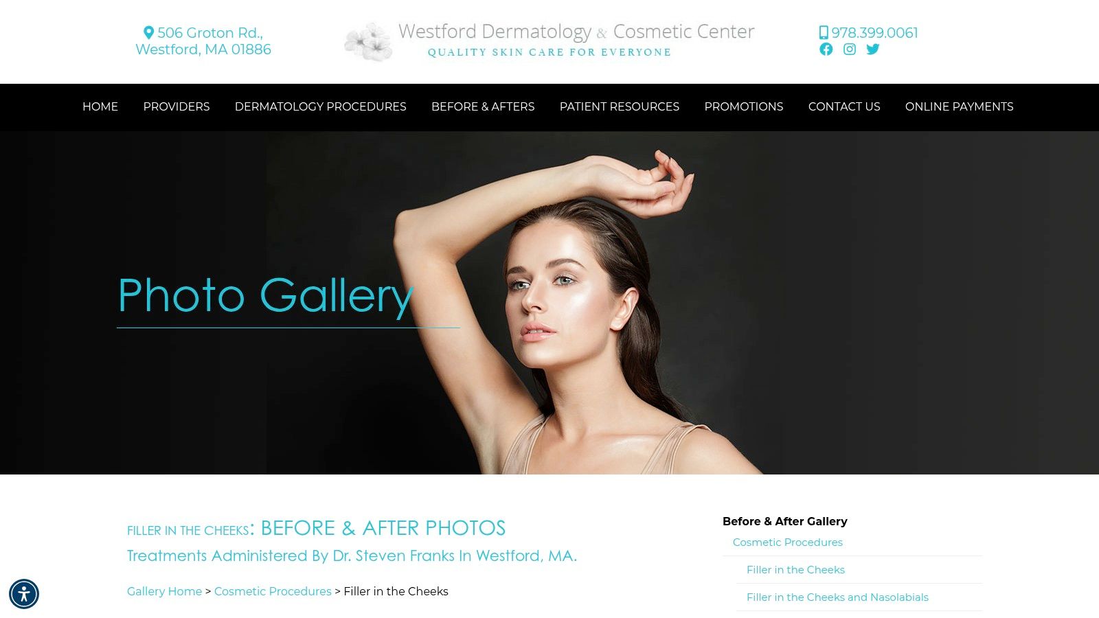 Westford Dermatology & Cosmetic Center – Filler in the Cheeks: Before & After