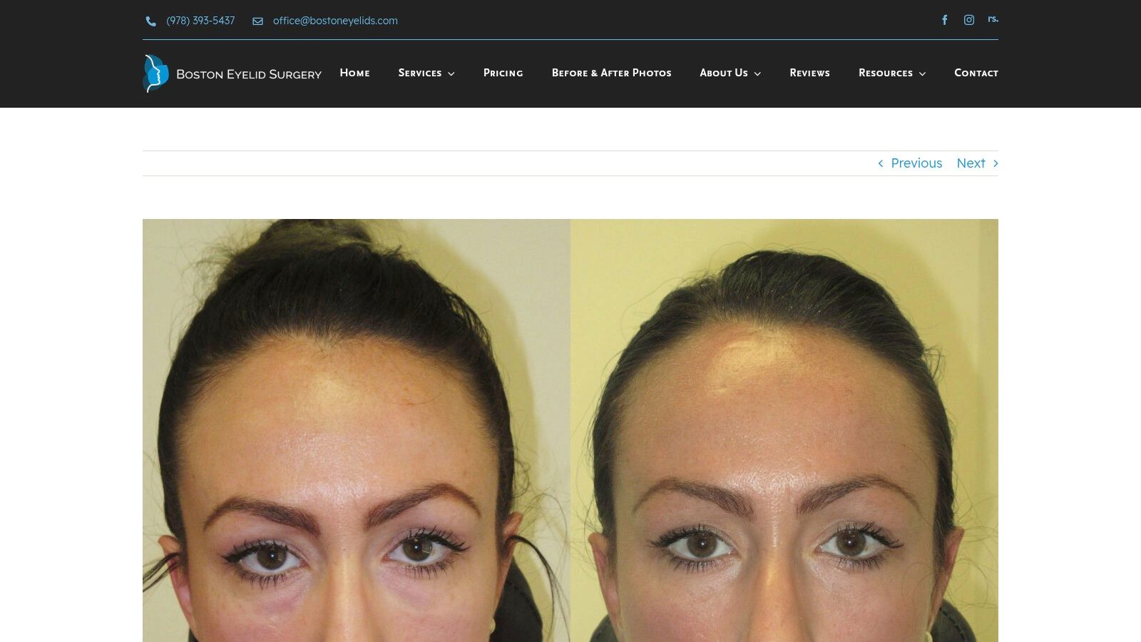 Boston Eyelid Surgery (Wellesley, MA) – Lower Eyelid, Midface, and Cheek Fillers