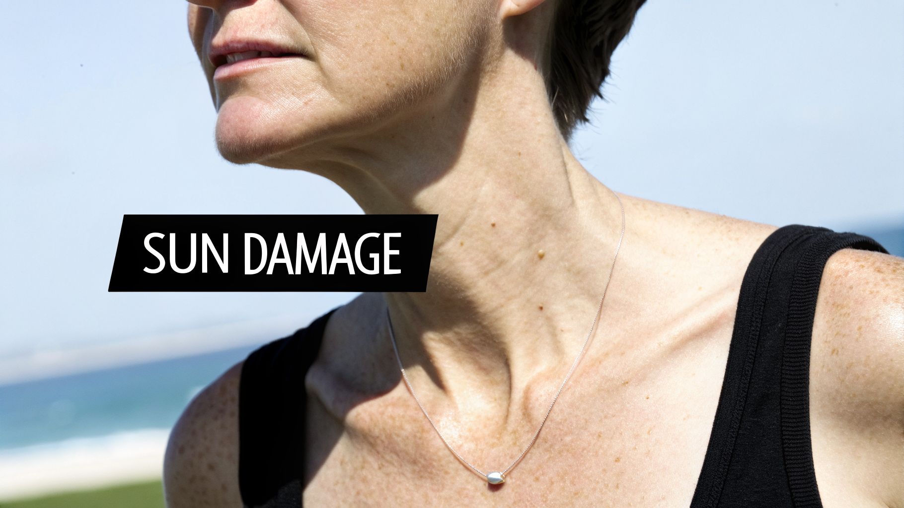 A person's neck and chest with visible sun damage, freckles, and a "SUN DAMAGE" label.