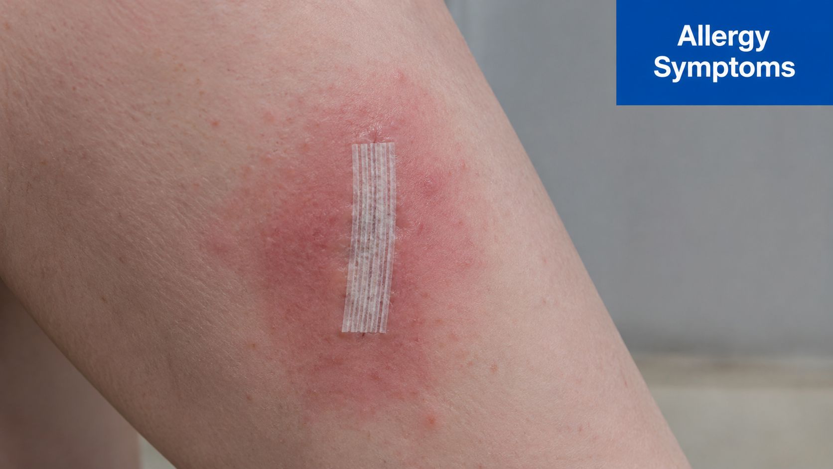 A close-up view of a red, inflamed area on skin around a surgical adhesive strip.