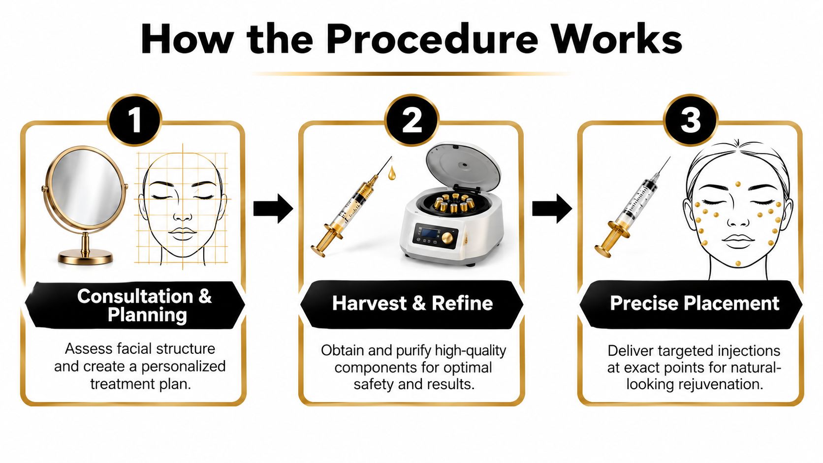 A three-step infographic illustrating the facial fat transfer procedure from consultation to harvest, refinement, and injection.