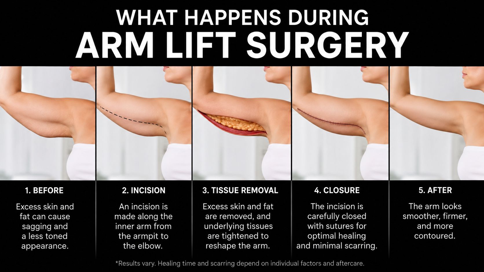 A step-by-step visual infographic explaining the five stages of brachioplasty, or arm lift surgery, from before to after.