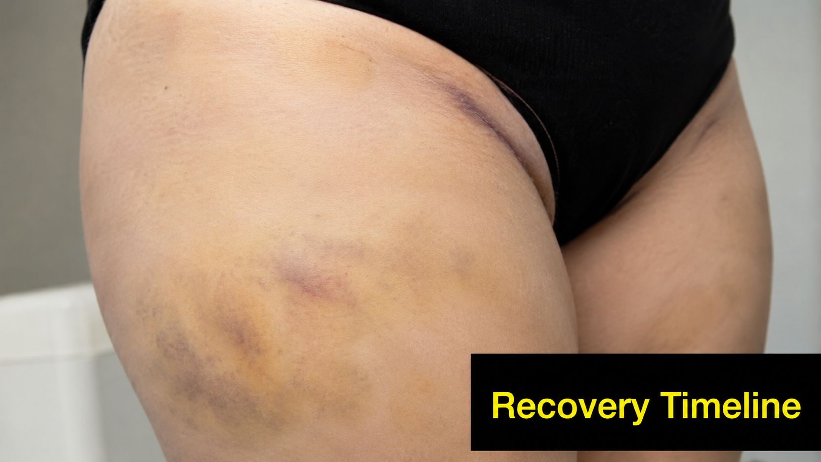 A close-up view of a patient's thigh showing significant yellow bruising following a surgical procedure.