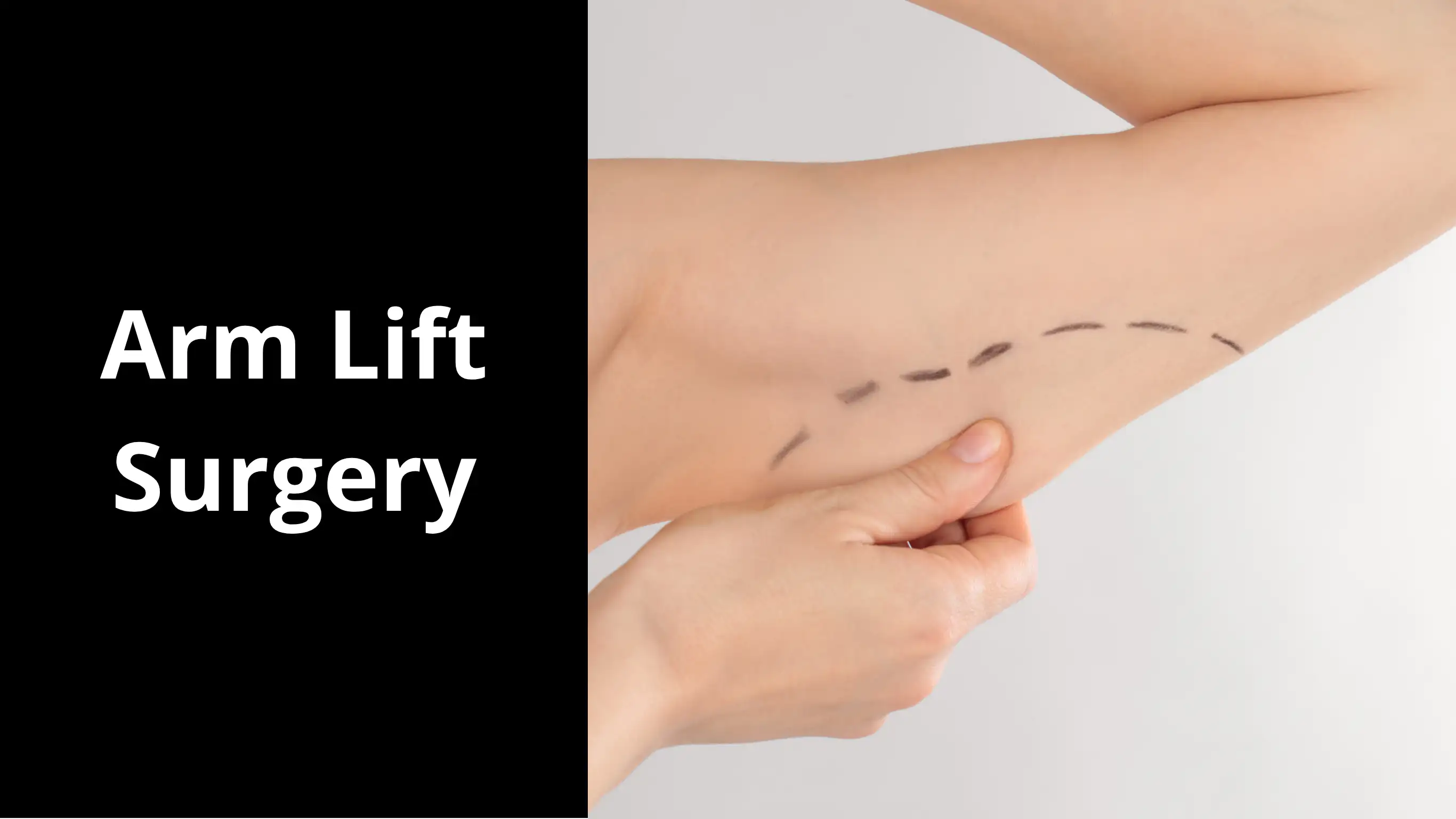Arm Lift Surgery Explained: A Patient's Complete Guide