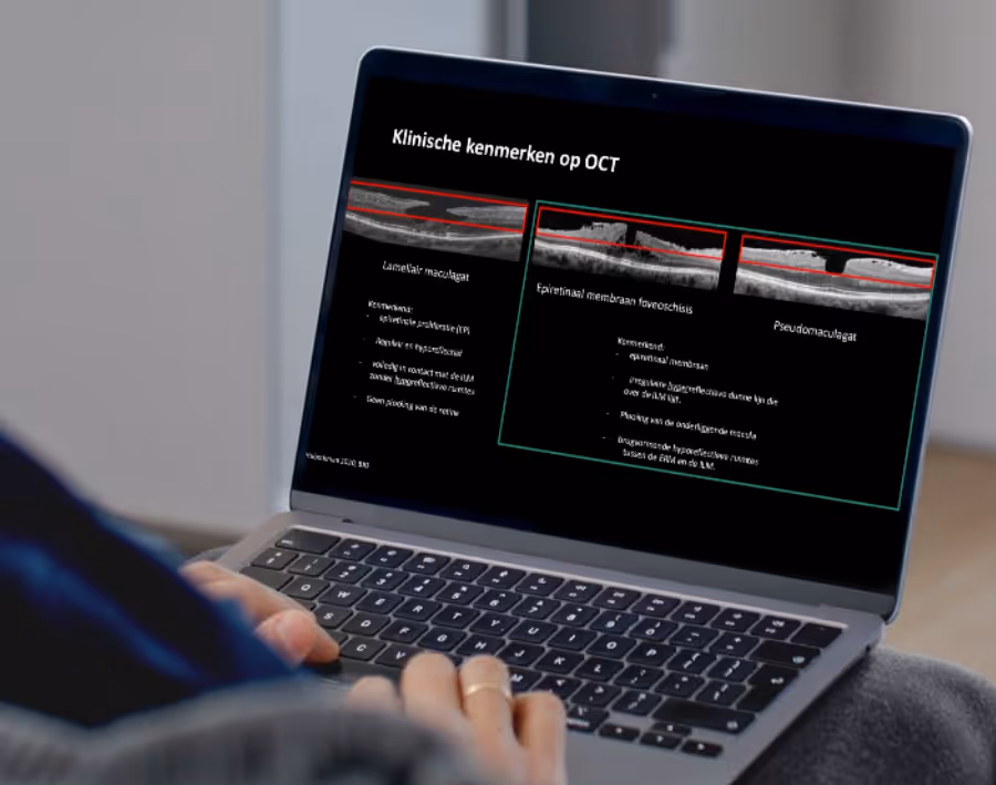 OCT-scan voorbeeld van maculaire afwijking voor oogheelkundige diagnostiek