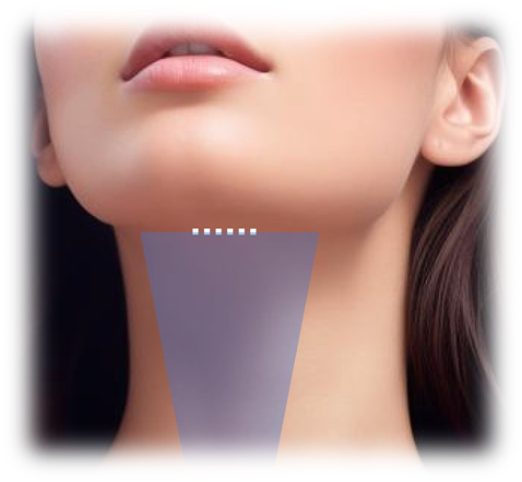 Mini Neck Lift or Median Neck Lift