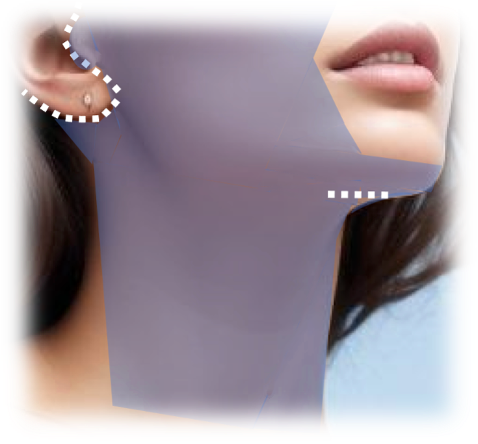 Deep Necklift and Deep plane Facelift