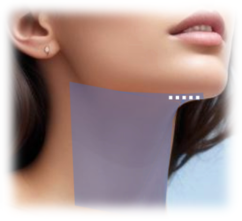 Deep Neck Lift