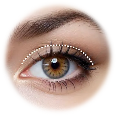 Direct Browlift