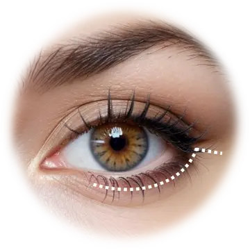 Temporal Browlift