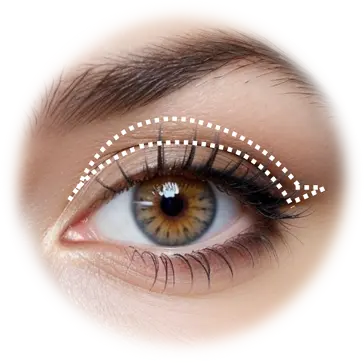 Endoscopic Browlift