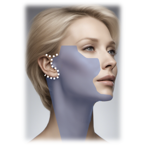 Deep plane facelift and necklift