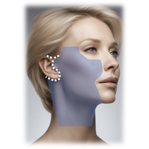 Deep plane facelift