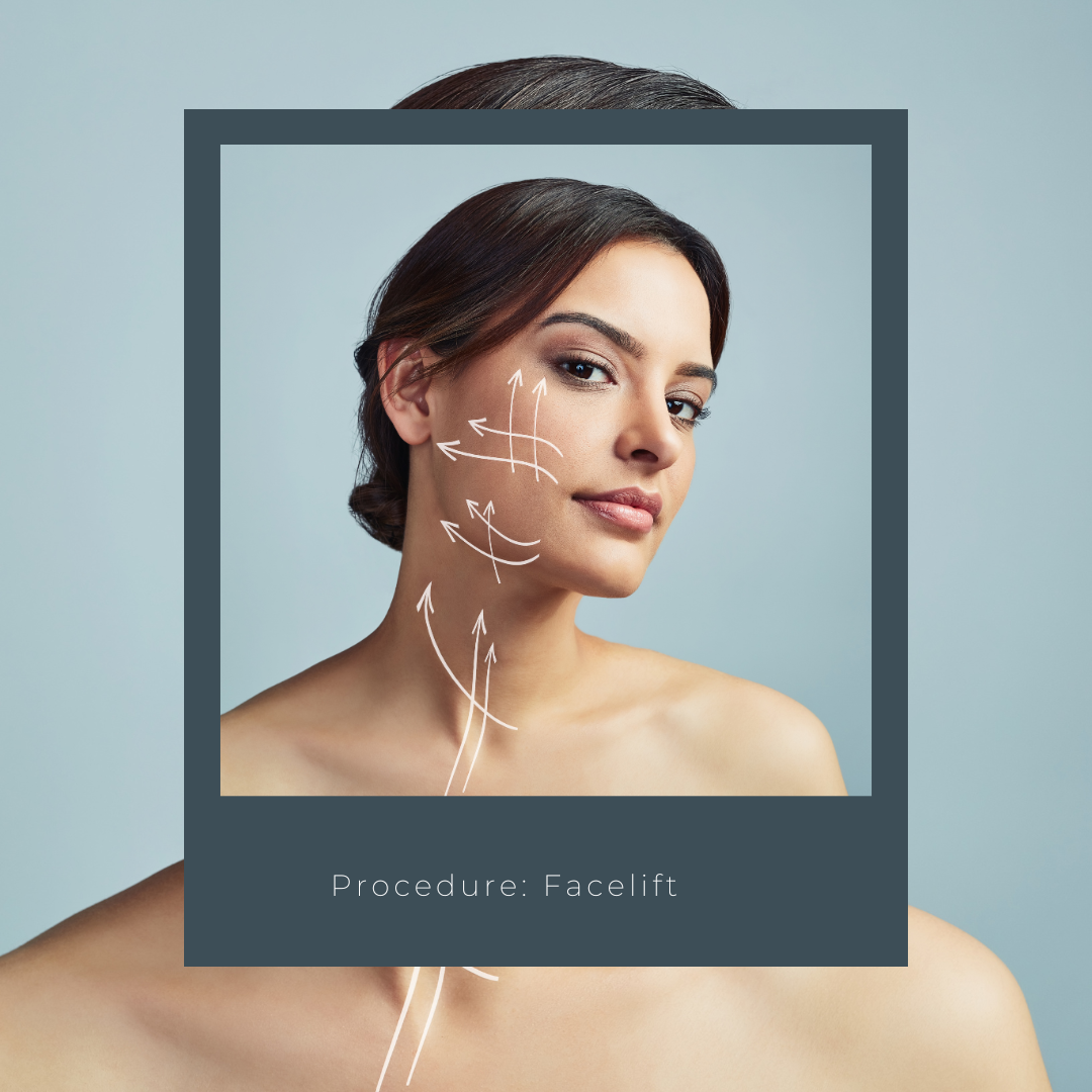 Procedure: Facelift