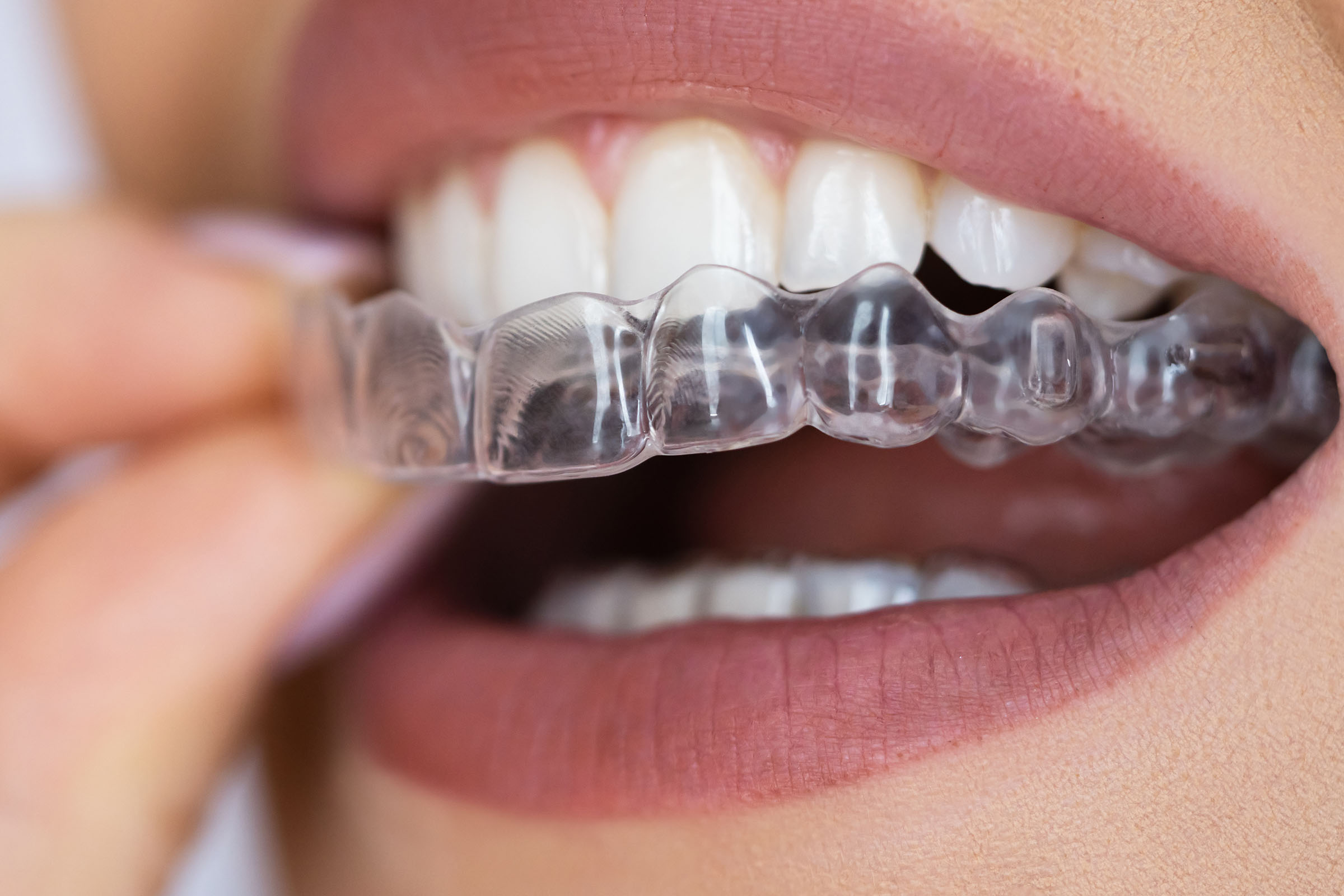 A women showing her invisalign