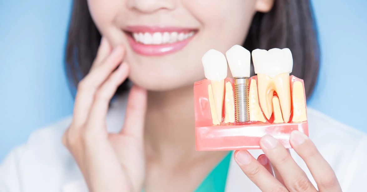 Photo of Dental Implants service