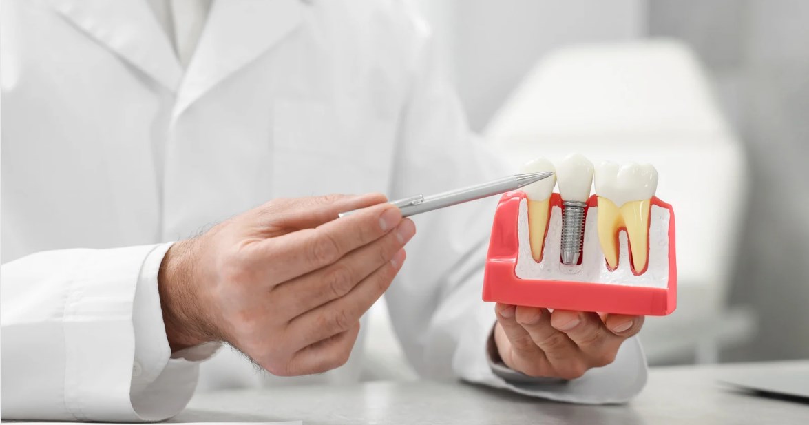 Are You a Good Candidate for Dental Implants?