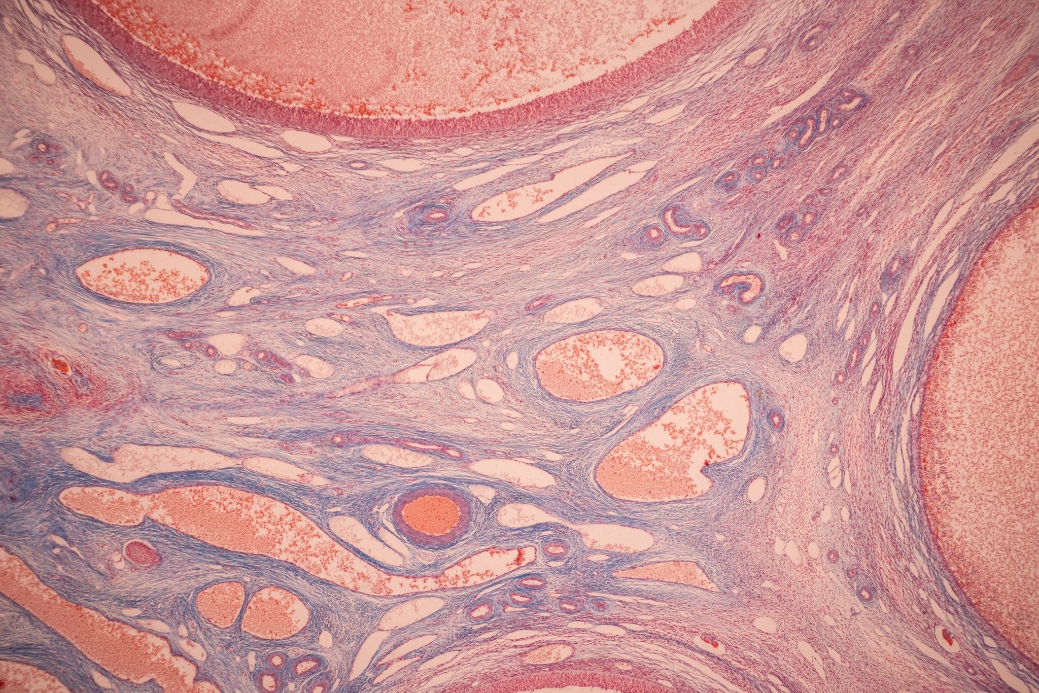 Sertoli cell-only syndrome