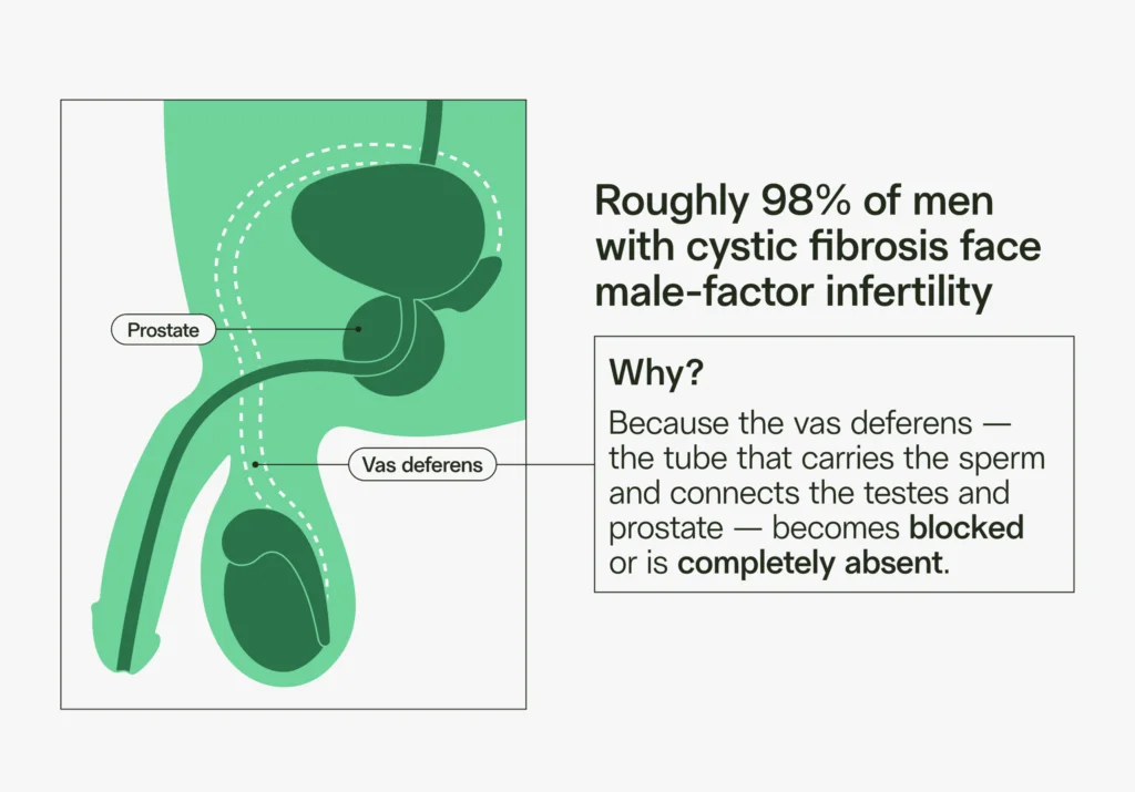 cystic fibrosis causes male-factor infertility in 98% of men