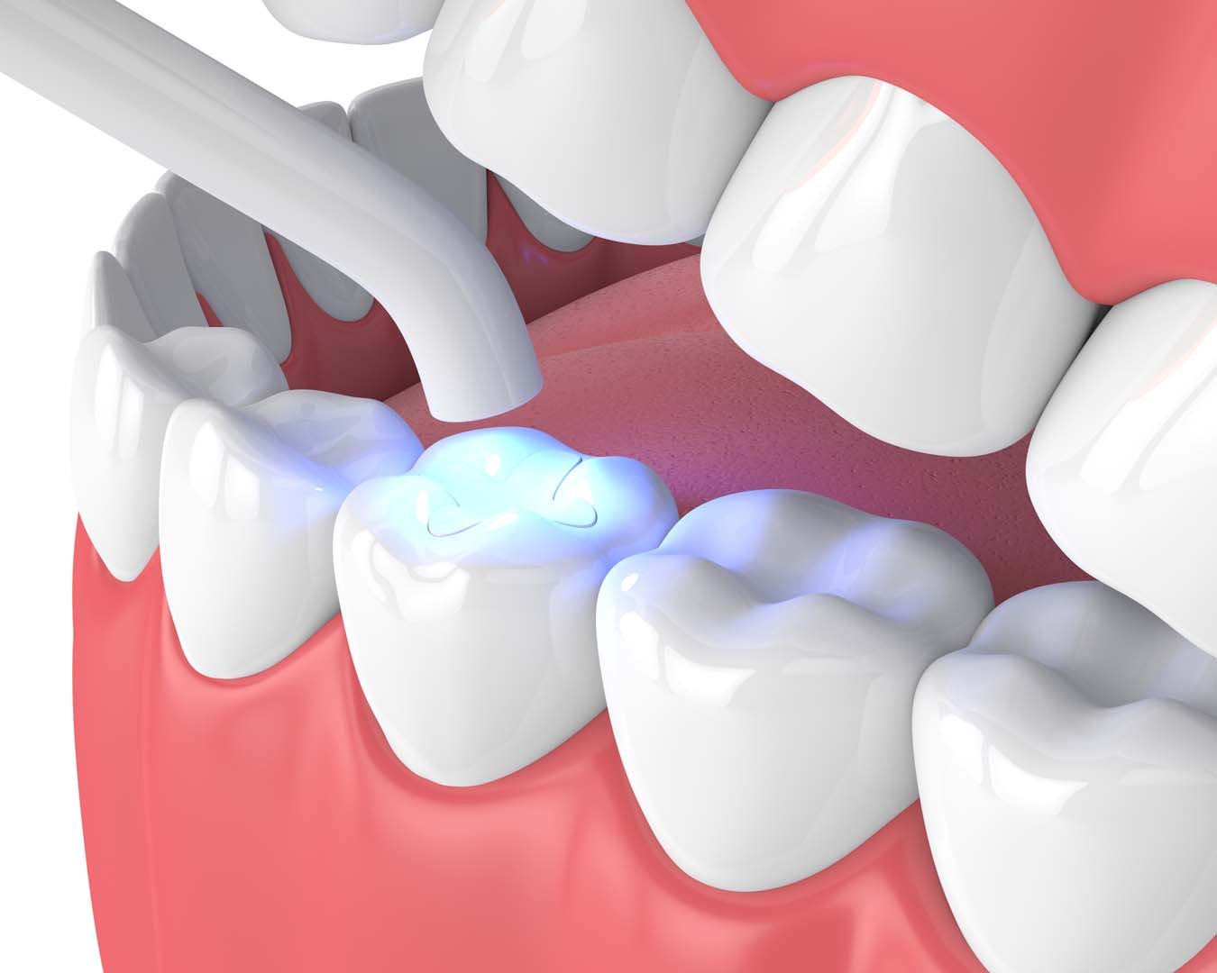 Tooth-Colored Fillings in Red Bank, NJ