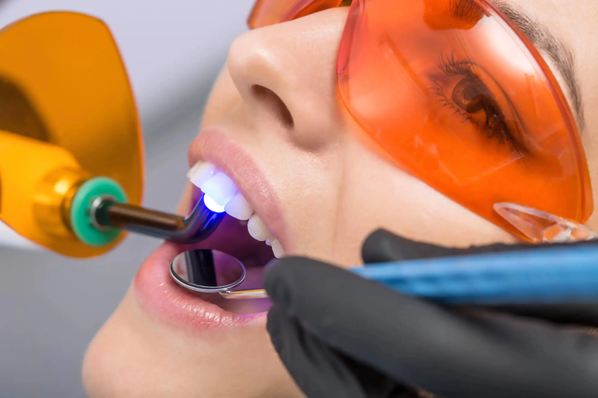 Close-up of dental laser curing brightening a patient's teeth with protective orange glasses.