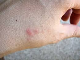 bed bug bite on hand