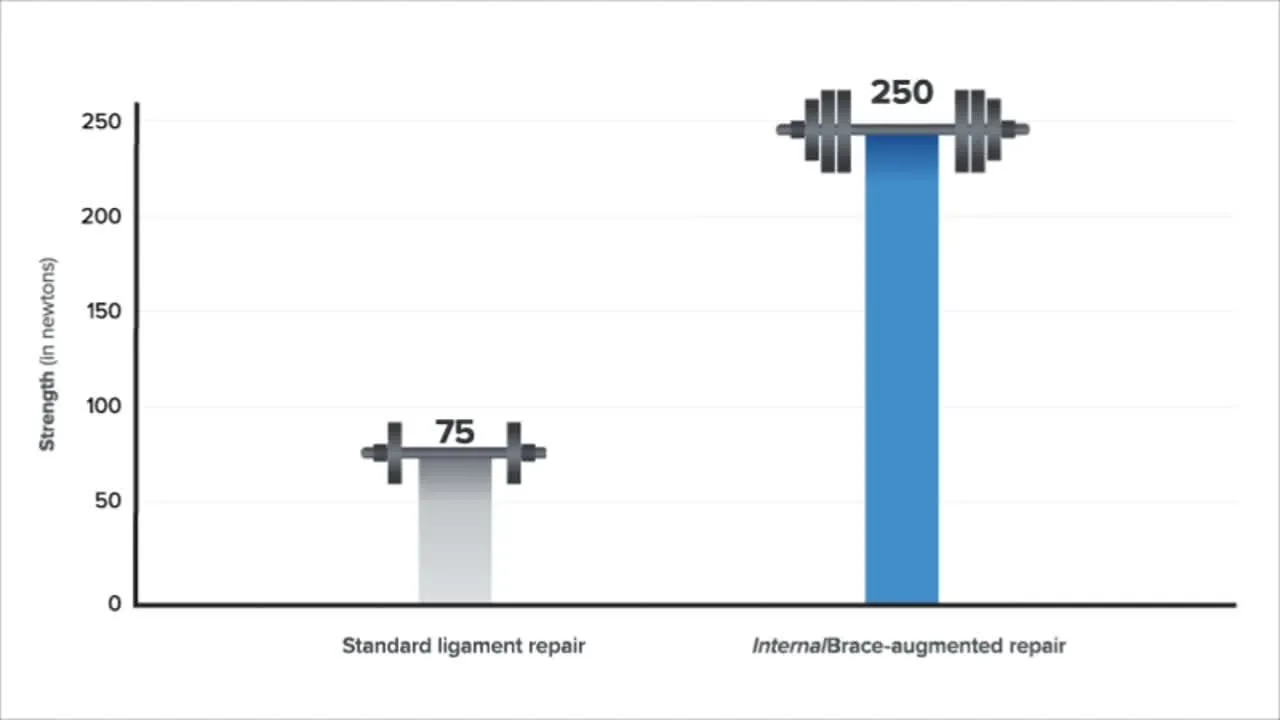 Bar graph comparing ligament strength after repair: Standard ligament repair at 75 newtons versus InternalBrace-augmented repair at 250 newtons, illustrating stronger ankle stabilization.