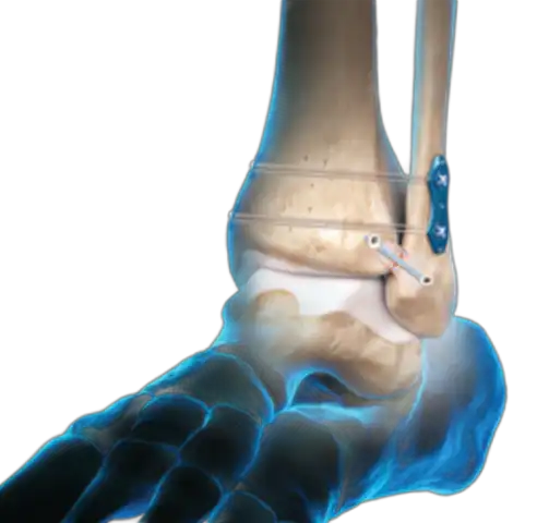 Medical illustration showing ankle surgical treatments: Syndesmosis TightRope procedure on the left and InternalBrace procedure on the right.
