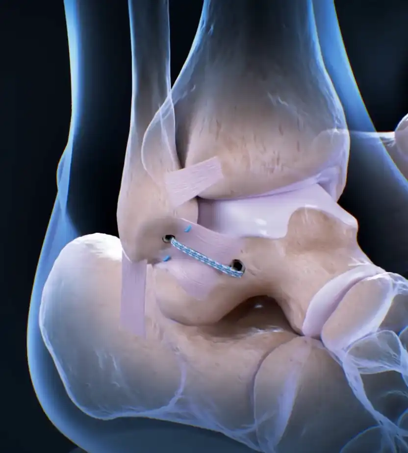 Medical illustration showing ankle surgical treatments: Syndesmosis TightRope procedure on the left and InternalBrace procedure on the right.